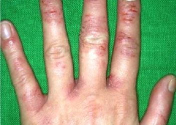 Eczema – What causes it and how can you help get rid of it