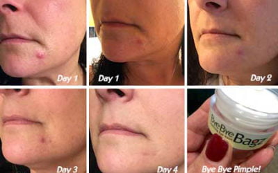 Bye Bye Pimples with Bye Bye Bagz