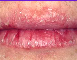 Why do lips chap and sometimes bleed? Why do cuticles tear and crack?