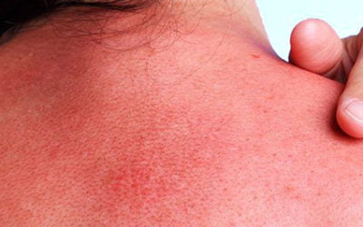 Ouch! Sunburn hurts. What to do right away and after
