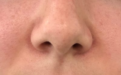 Pore Size! Can I Really Shrink Them?