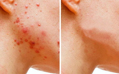 Adult Acne Sucks! What The Heck Happened To My Skin?
